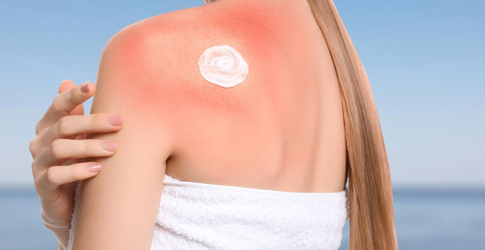 alergija-na-sonce-simptomi-zascita